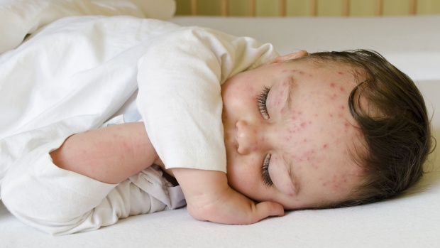 Waspada Flu Singapura Menjangkit Anak-anak, Ini 6 Cara Pencegahannya