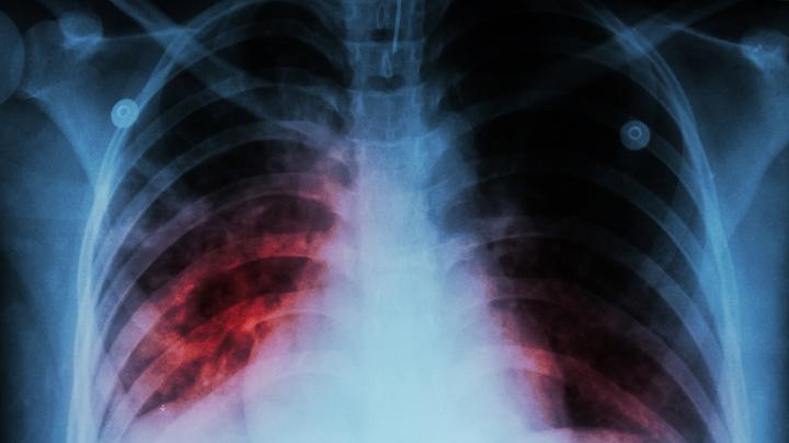 Perlu Pengendalian Penularan Penyakit Lewat Udara Demi Ketahanan Kesehatan Nasional
