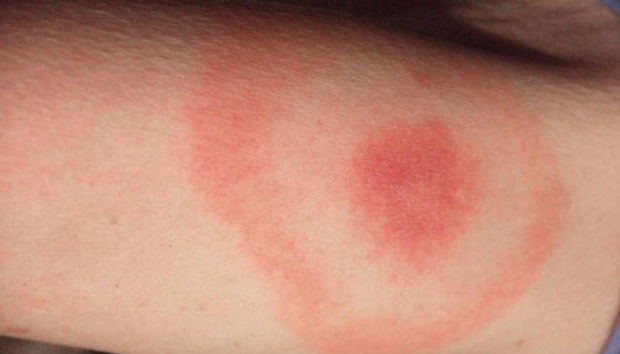 Punya Efek yang Parah, Bisakah Penyakit Lyme Disembuhkan?